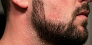 Extreme close-up of a man's jaw and neck, showing red, irritated skin and visible razor bumps near the edge of his short beard.